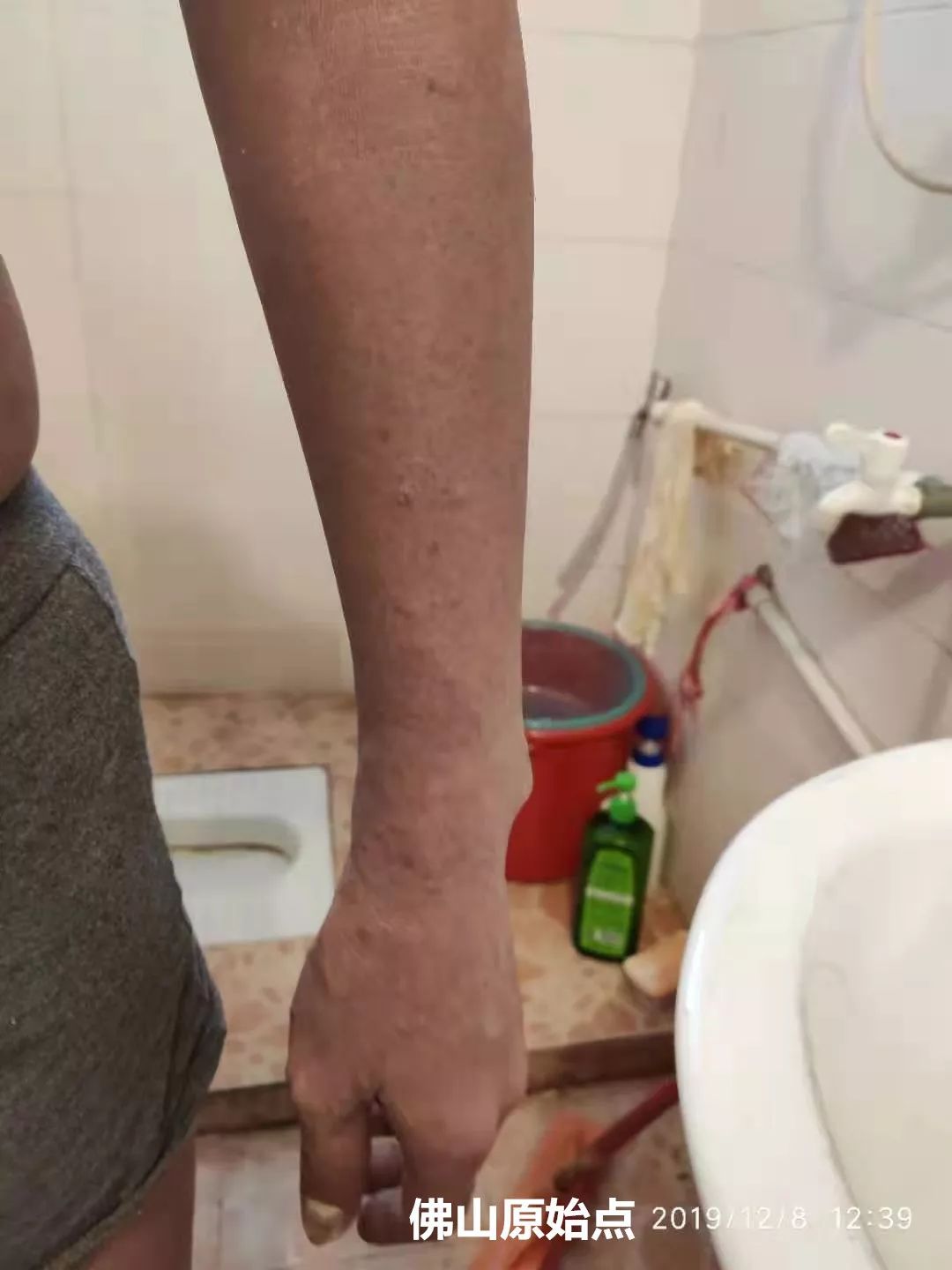 原始点调理十年牛皮癣案例 原始点调理十年牛皮癣案例