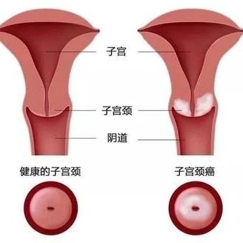 【原始点案例】宫颈糜烂调理-原始点全球同学网