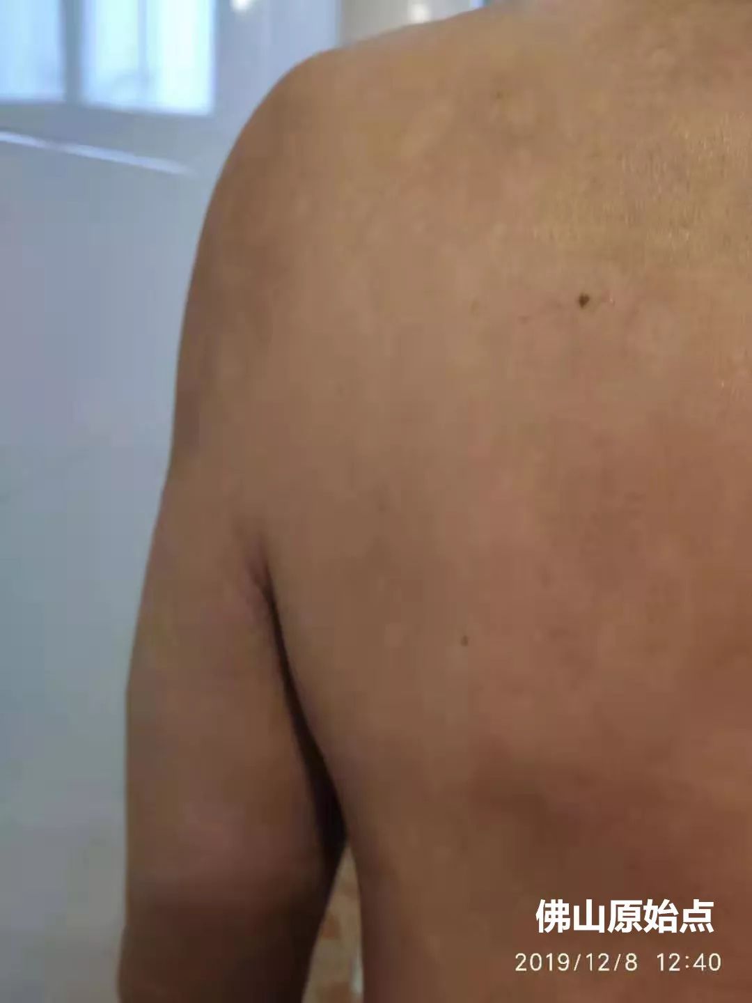 原始点调理十年牛皮癣案例 原始点调理十年牛皮癣案例