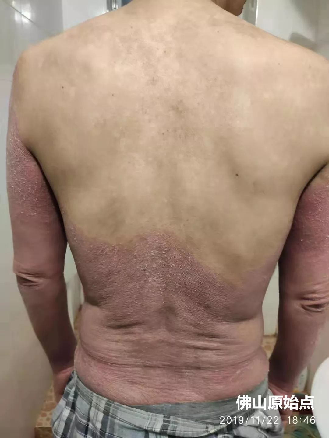 原始点调理十年牛皮癣案例 原始点调理十年牛皮癣案例