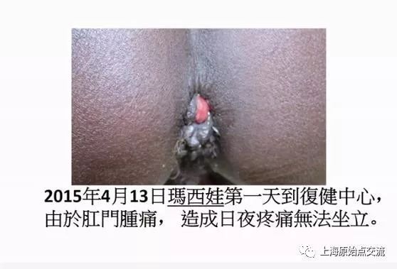 原始点处理痔疮案例合集 原始点处理痔疮案例合集