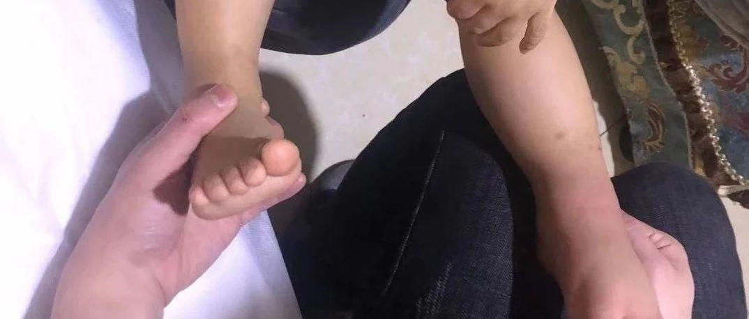 案例分享：原始点调理小孩荨麻疹，脚肿的案例。-原始点全球同学网