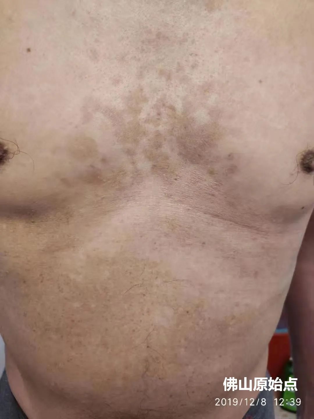 原始点调理十年牛皮癣案例 原始点调理十年牛皮癣案例