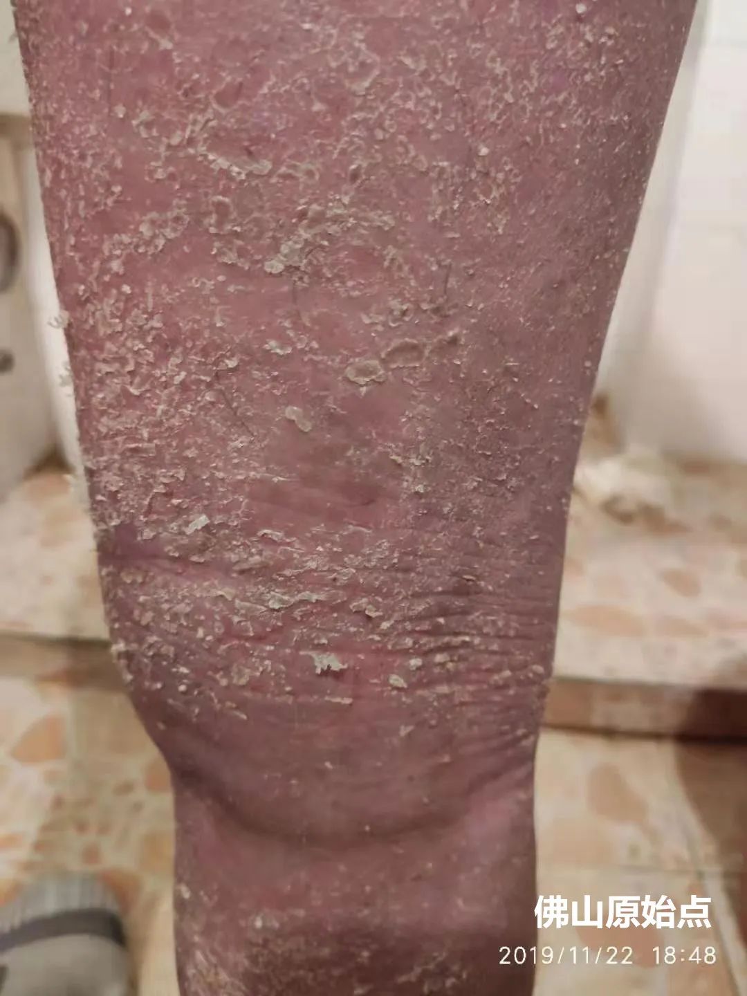 原始点调理十年牛皮癣案例 原始点调理十年牛皮癣案例