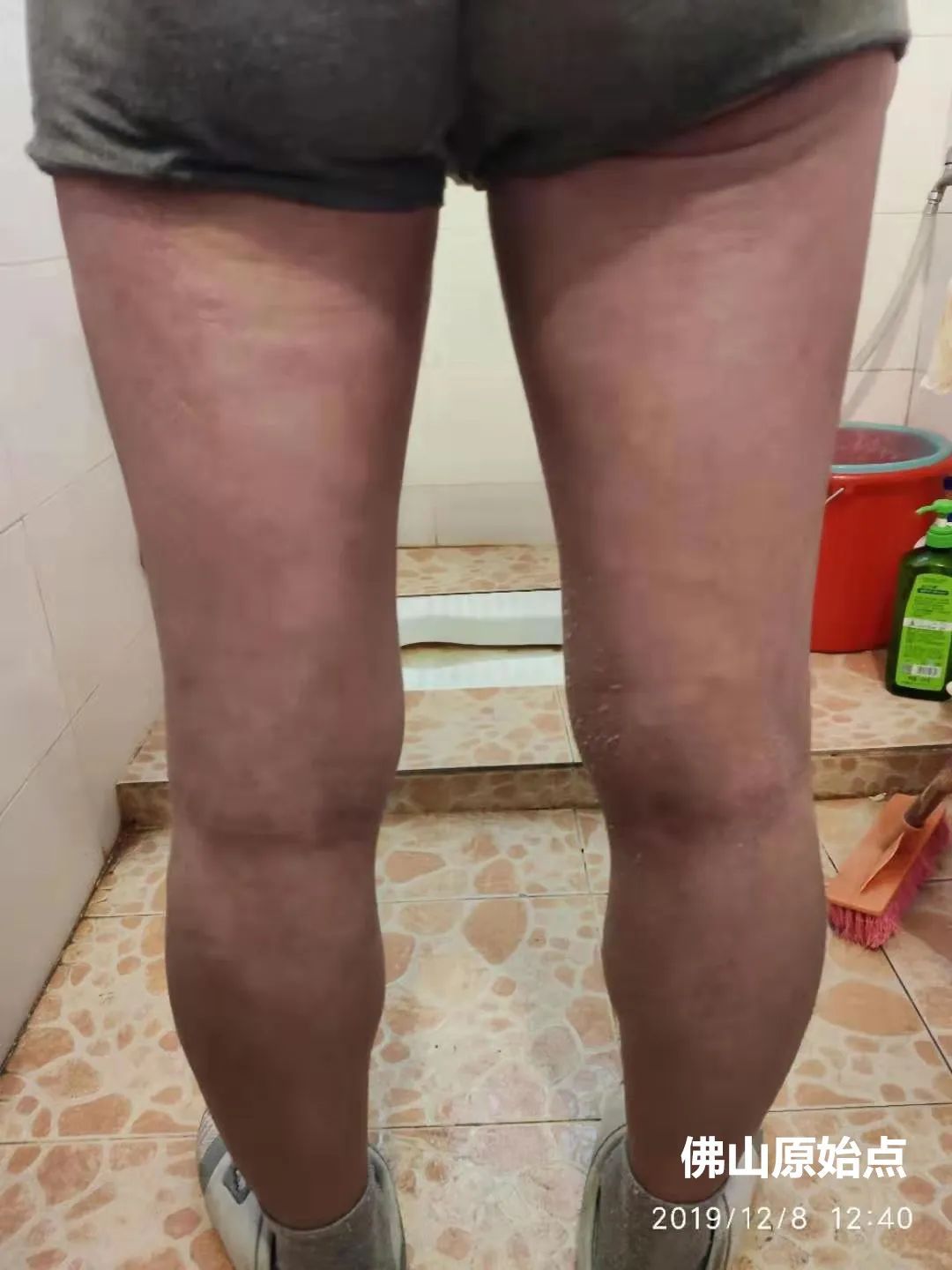 原始点调理十年牛皮癣案例 原始点调理十年牛皮癣案例