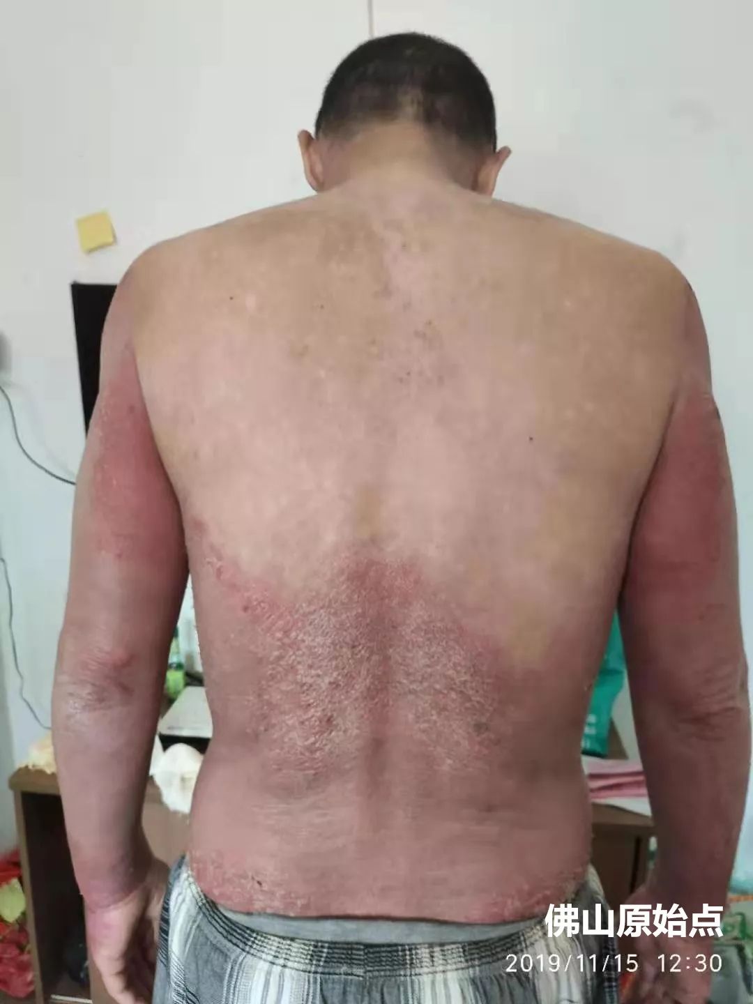 原始点调理十年牛皮癣案例 原始点调理十年牛皮癣案例