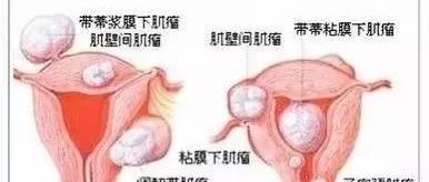 中医解读子宫肌瘤、卵巢囊肿是怎么回事？-原始点全球同学网