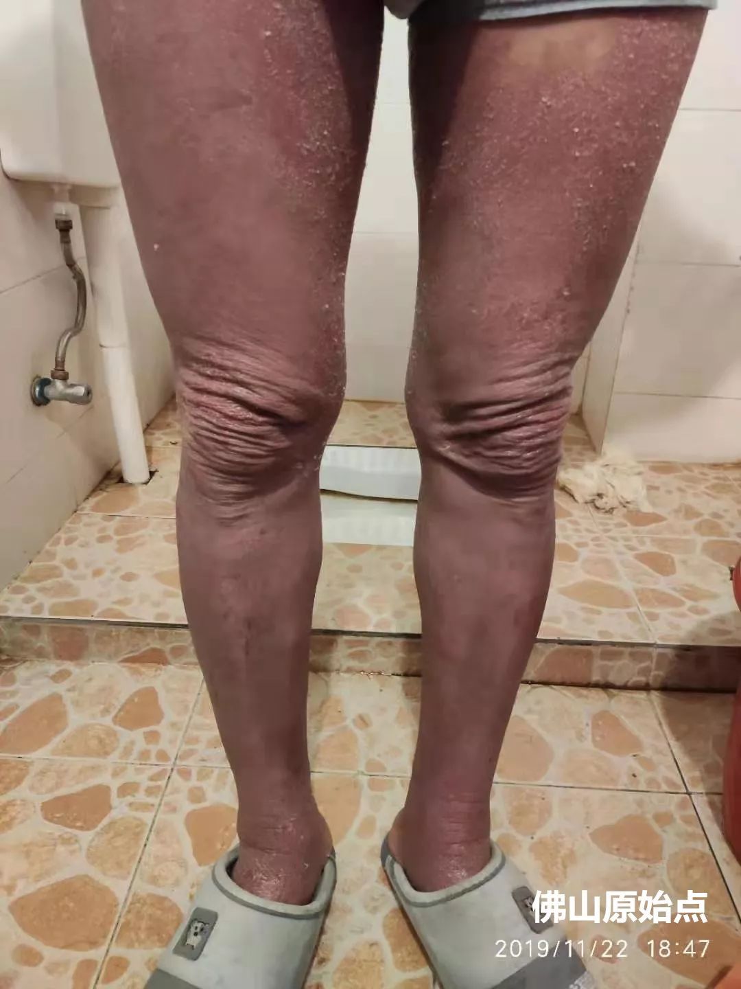 原始点调理十年牛皮癣案例 原始点调理十年牛皮癣案例