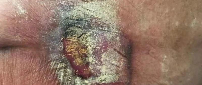 原始点快速调理褥疮案例-原始点全球同学网