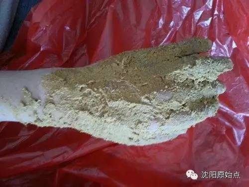 30年顽固湿疹15天痊愈 30年顽固湿疹15天痊愈