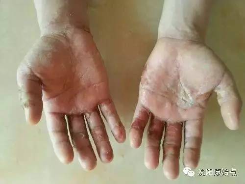 30年顽固湿疹15天痊愈 30年顽固湿疹15天痊愈