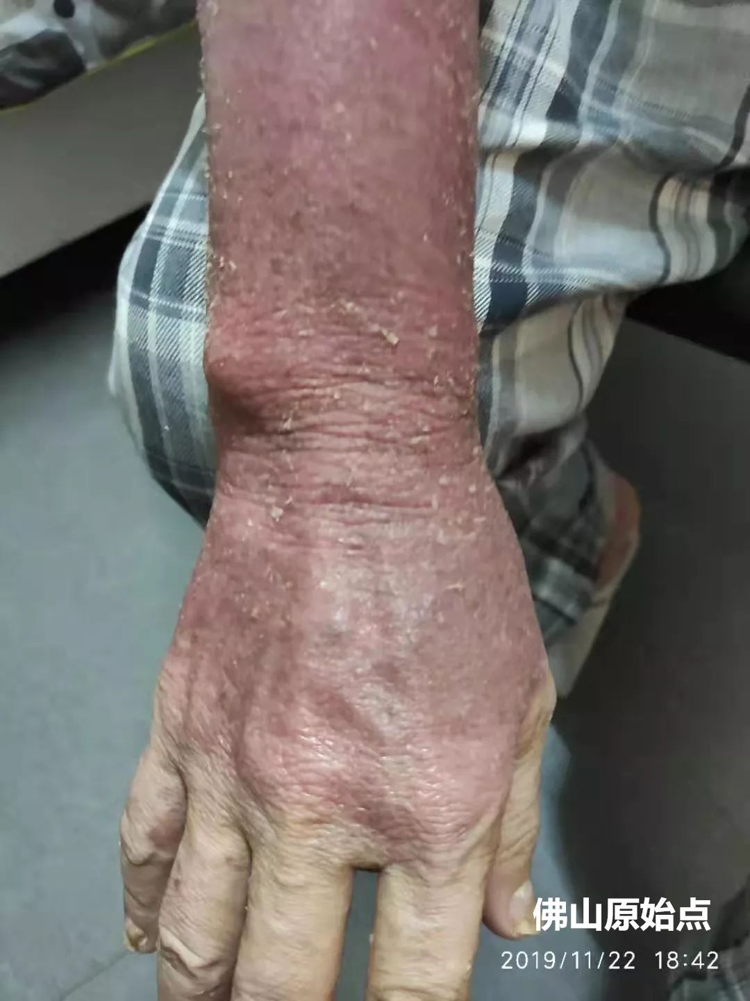 原始点调理十年牛皮癣案例 原始点调理十年牛皮癣案例