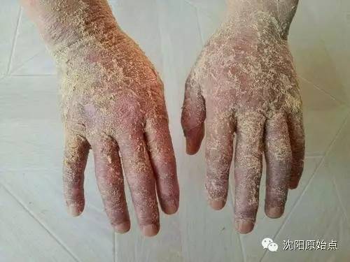 30年顽固湿疹15天痊愈 30年顽固湿疹15天痊愈