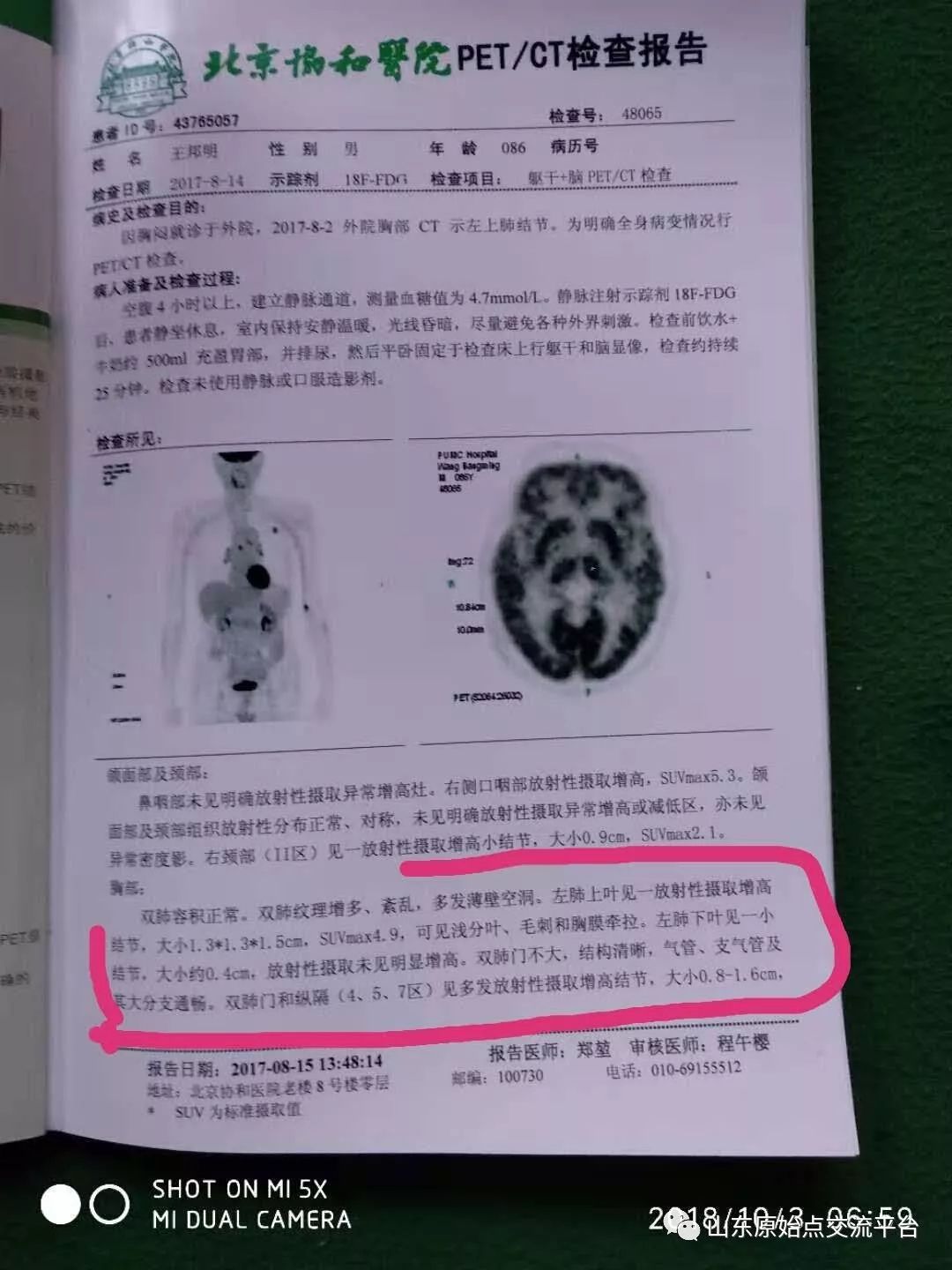 【原始点案例】河北泊头王先生肺癌康复案例 【原始点案例】河北泊头王先生肺癌康复案例