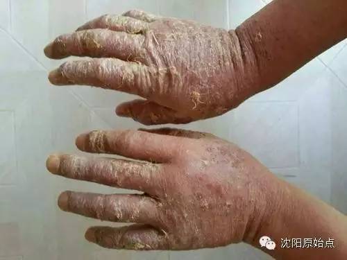 30年顽固湿疹15天痊愈 30年顽固湿疹15天痊愈