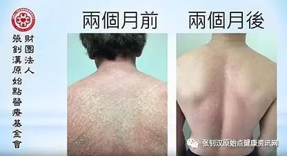 牛皮癣案例(日本人)-原始点全球同学网