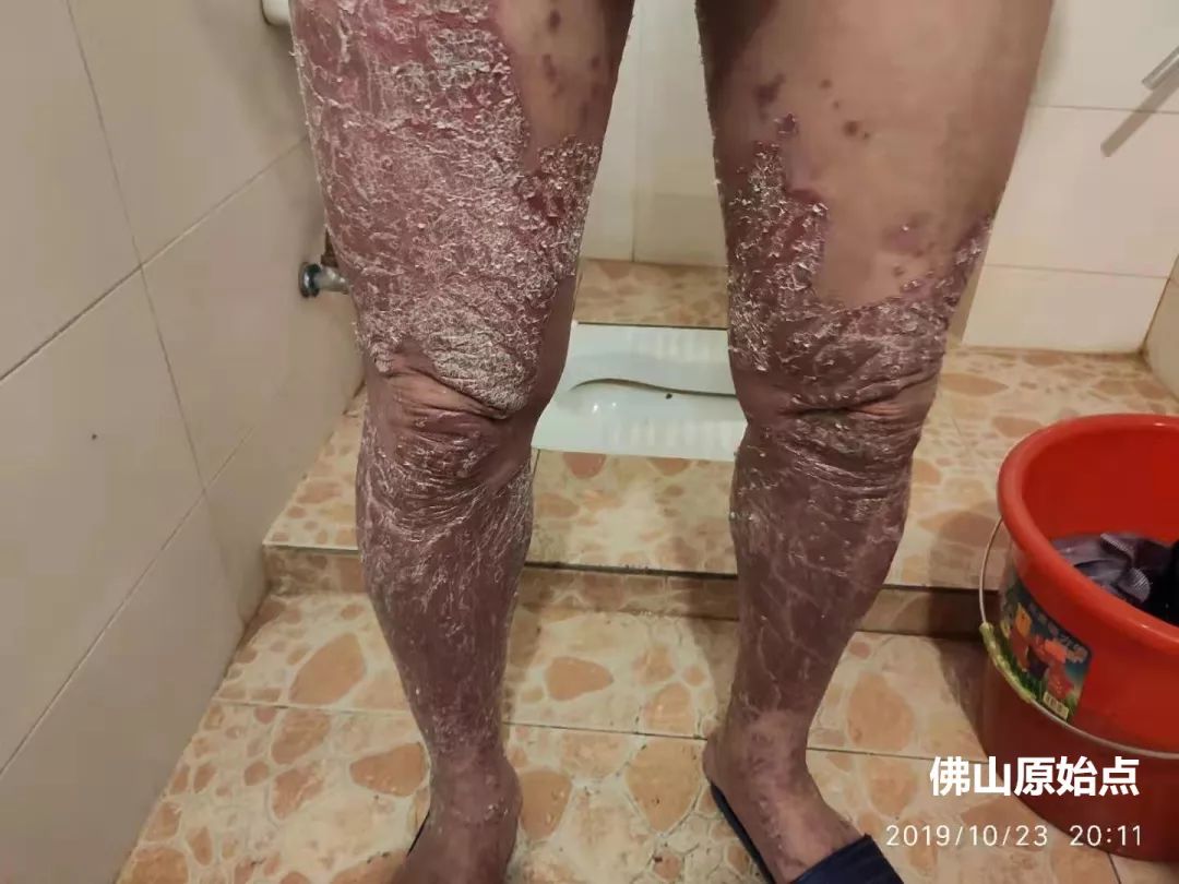 原始点调理十年牛皮癣案例 原始点调理十年牛皮癣案例