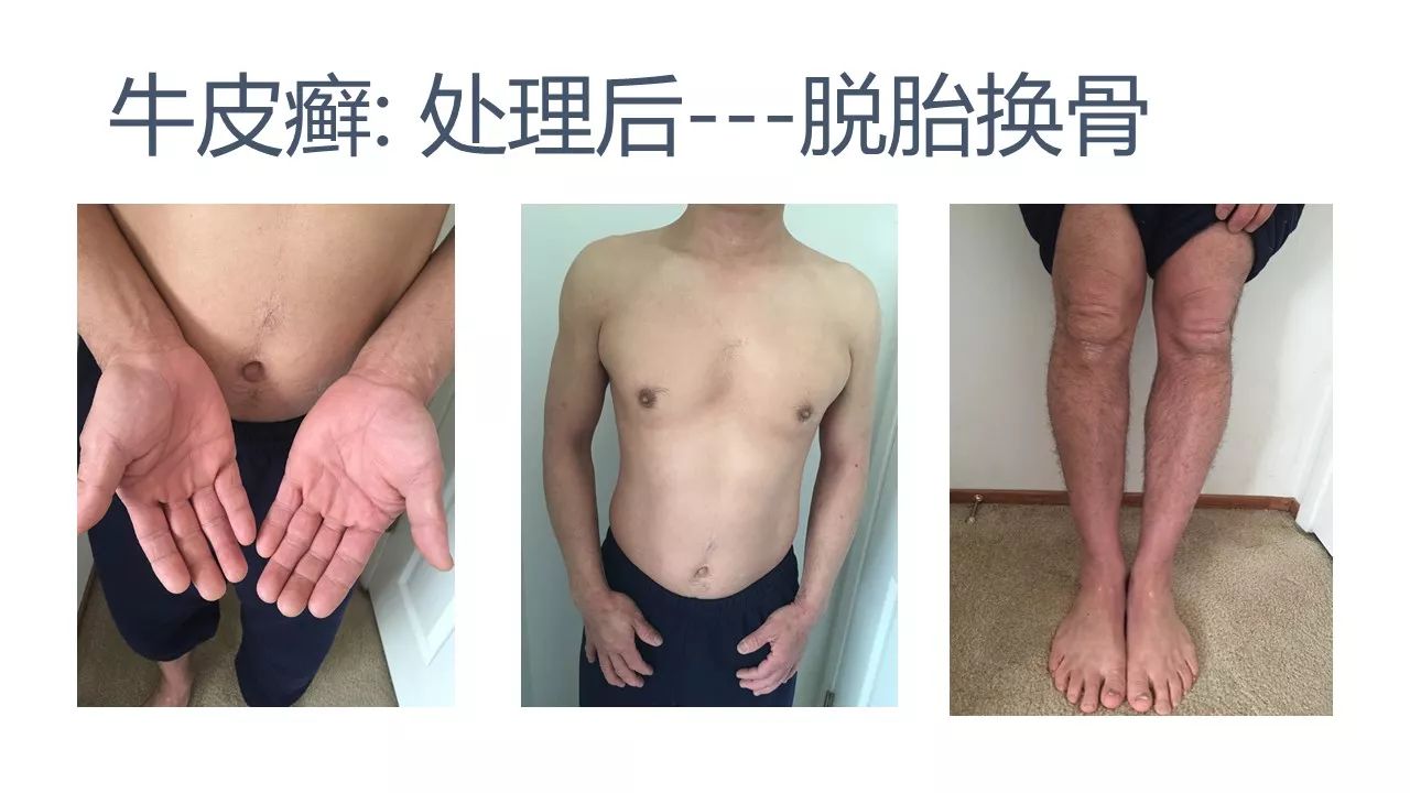 牛皮癣案例(日本人)(后续追踪)(字幕版) 牛皮癣案例(日本人)(后续追踪)(字幕版)