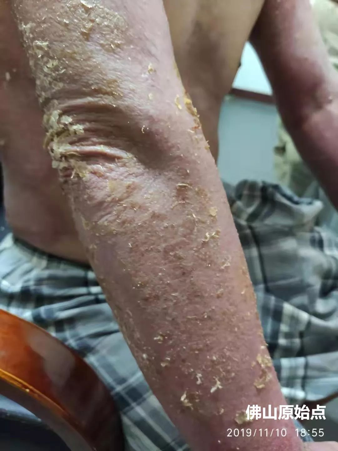 原始点调理十年牛皮癣案例 原始点调理十年牛皮癣案例