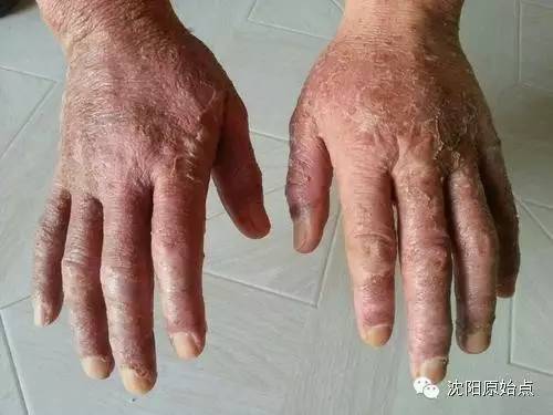 30年顽固湿疹15天痊愈 30年顽固湿疹15天痊愈