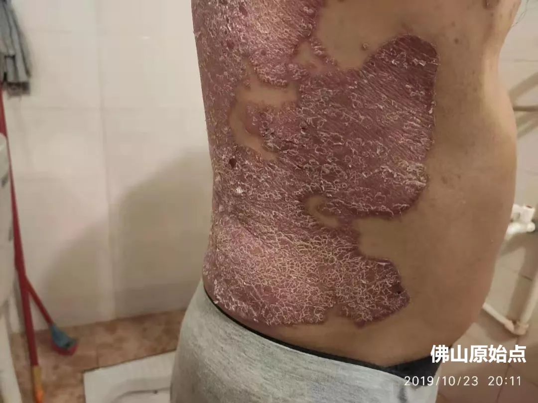 原始点调理十年牛皮癣案例 原始点调理十年牛皮癣案例