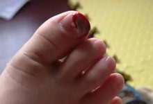 小孩指甲受伤,第二天就能踢球-原始点全球同学网