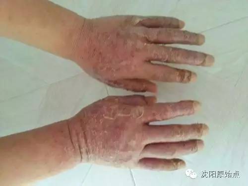 带状疱疹案例 30年顽固湿疹 便秘、肚子痛被折腾到接近命危案例 带状疱疹案例 30年顽固湿疹 便秘、肚子痛被折腾到接近命危案例