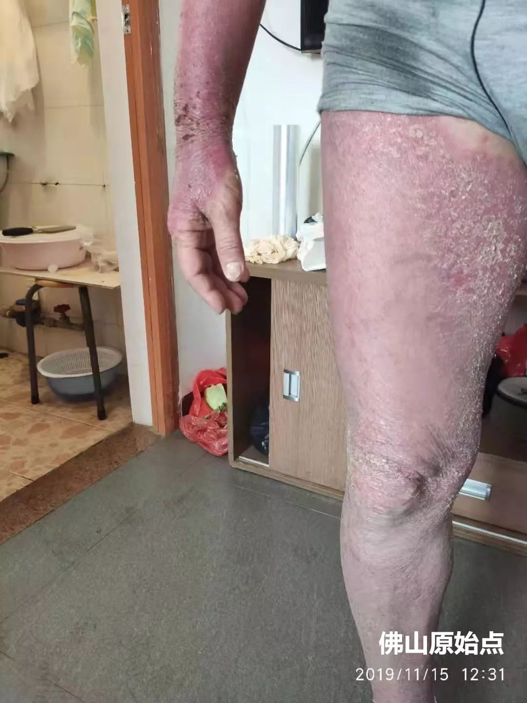 原始点调理十年牛皮癣案例 原始点调理十年牛皮癣案例