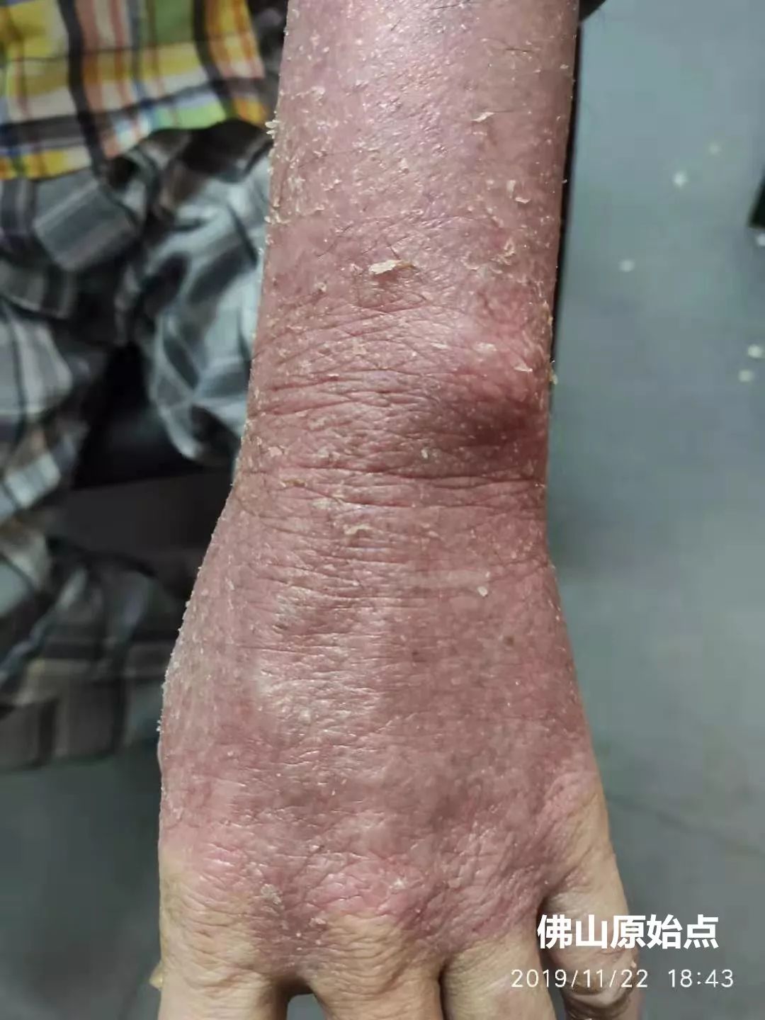 原始点调理十年牛皮癣案例 原始点调理十年牛皮癣案例