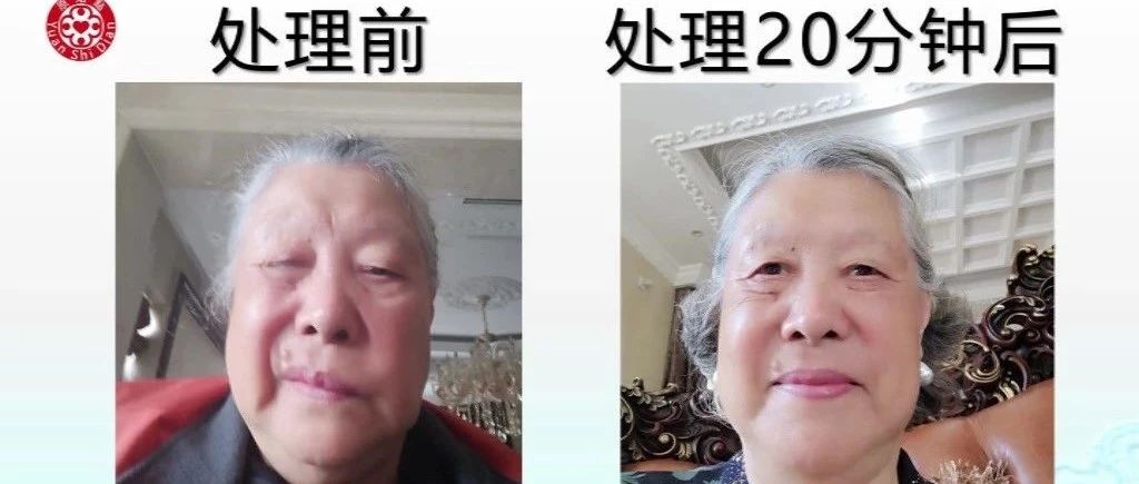 急性中风案例-原始点全球同学网