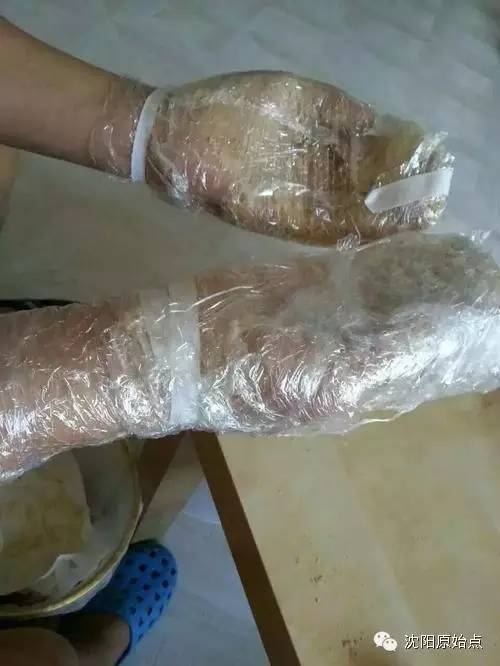 带状疱疹案例 30年顽固湿疹 便秘、肚子痛被折腾到接近命危案例 带状疱疹案例 30年顽固湿疹 便秘、肚子痛被折腾到接近命危案例