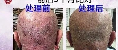 肺癌转脑癌案例-原始点全球同学网