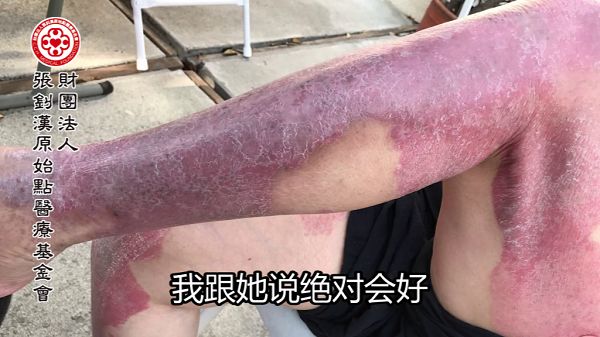 牛皮癣案例(美国) 牛皮癣案例(美国)