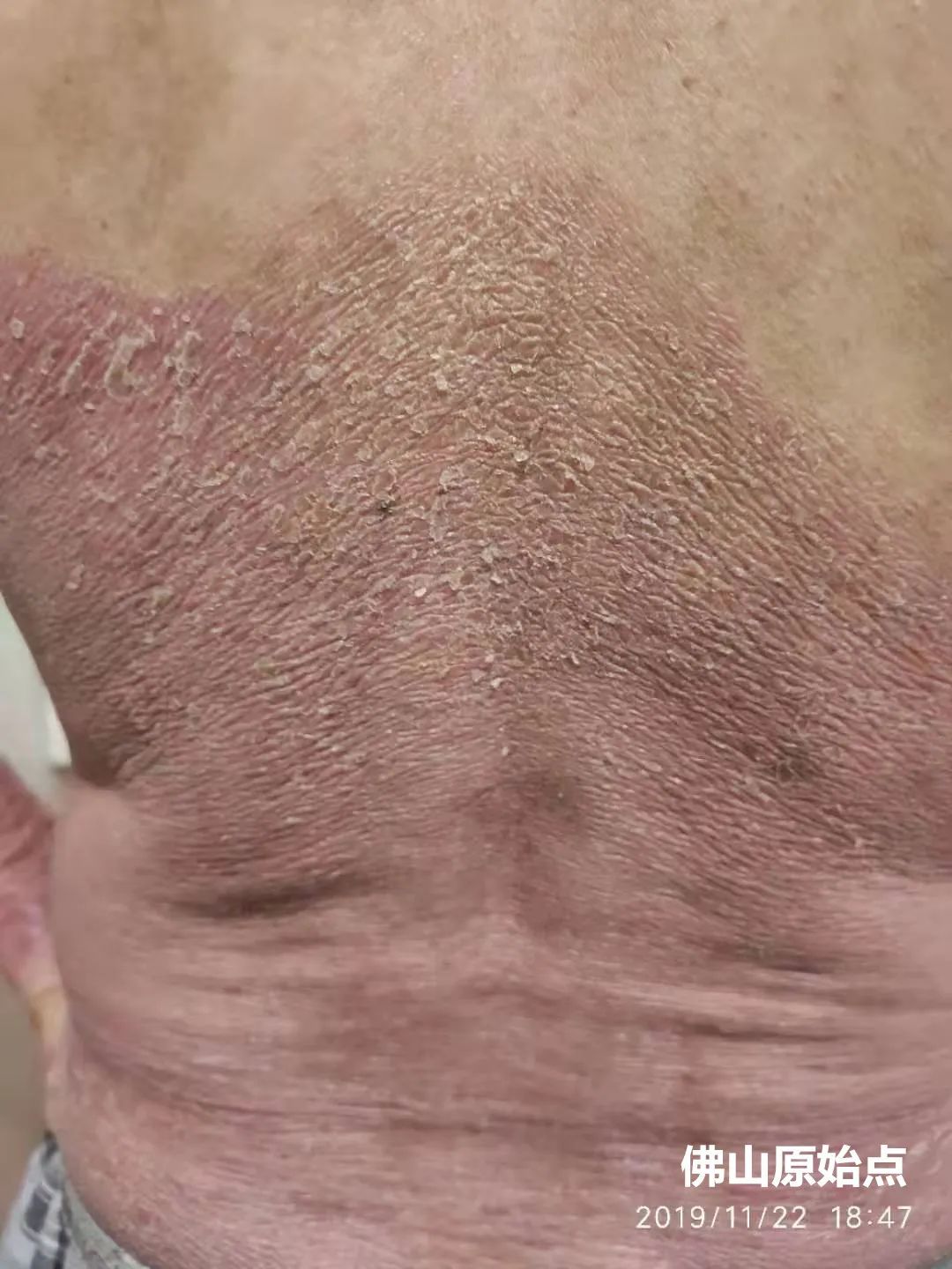 原始点调理十年牛皮癣案例 原始点调理十年牛皮癣案例