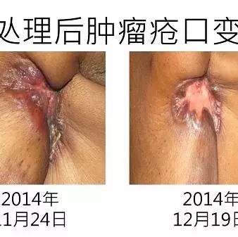 乳癌案例（若斯玲）（简体版）-原始点全球同学网