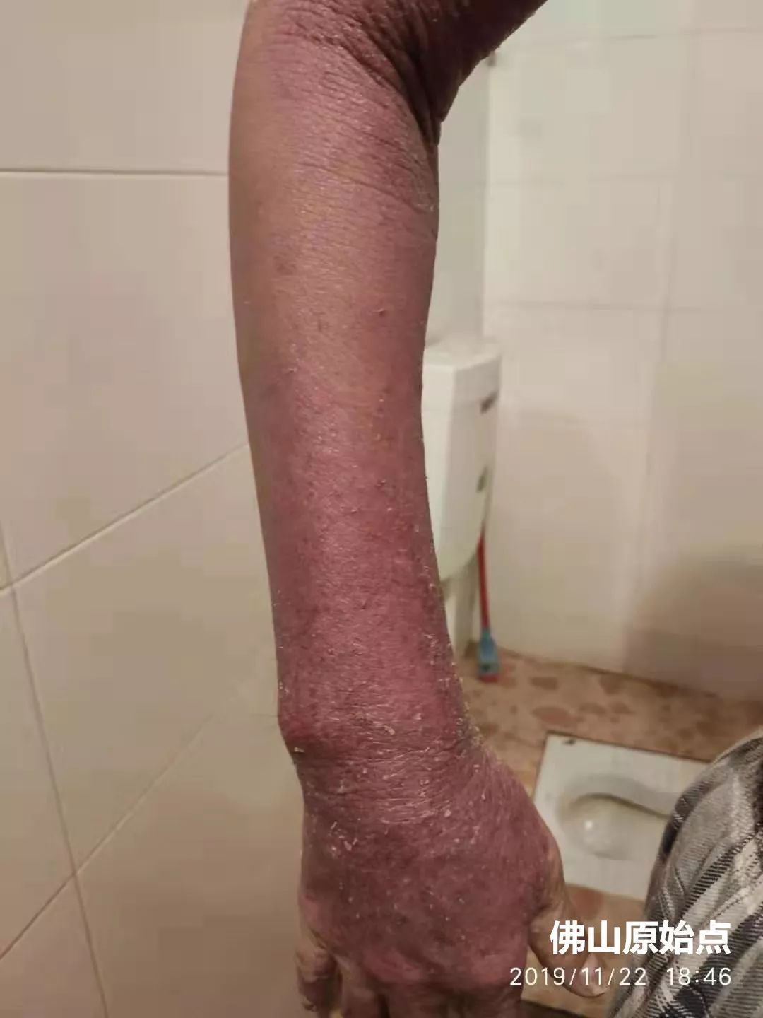 原始点调理十年牛皮癣案例 原始点调理十年牛皮癣案例