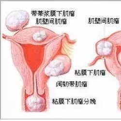 子宫肌瘤、乳腺癌原来是这么回事！看完我目瞪口呆！-原始点全球同学网