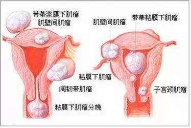 子宫肌瘤、乳腺癌原来是这么回事!看完我目瞪口呆! 子宫肌瘤、乳腺癌原来是这么回事!看完我目瞪口呆!