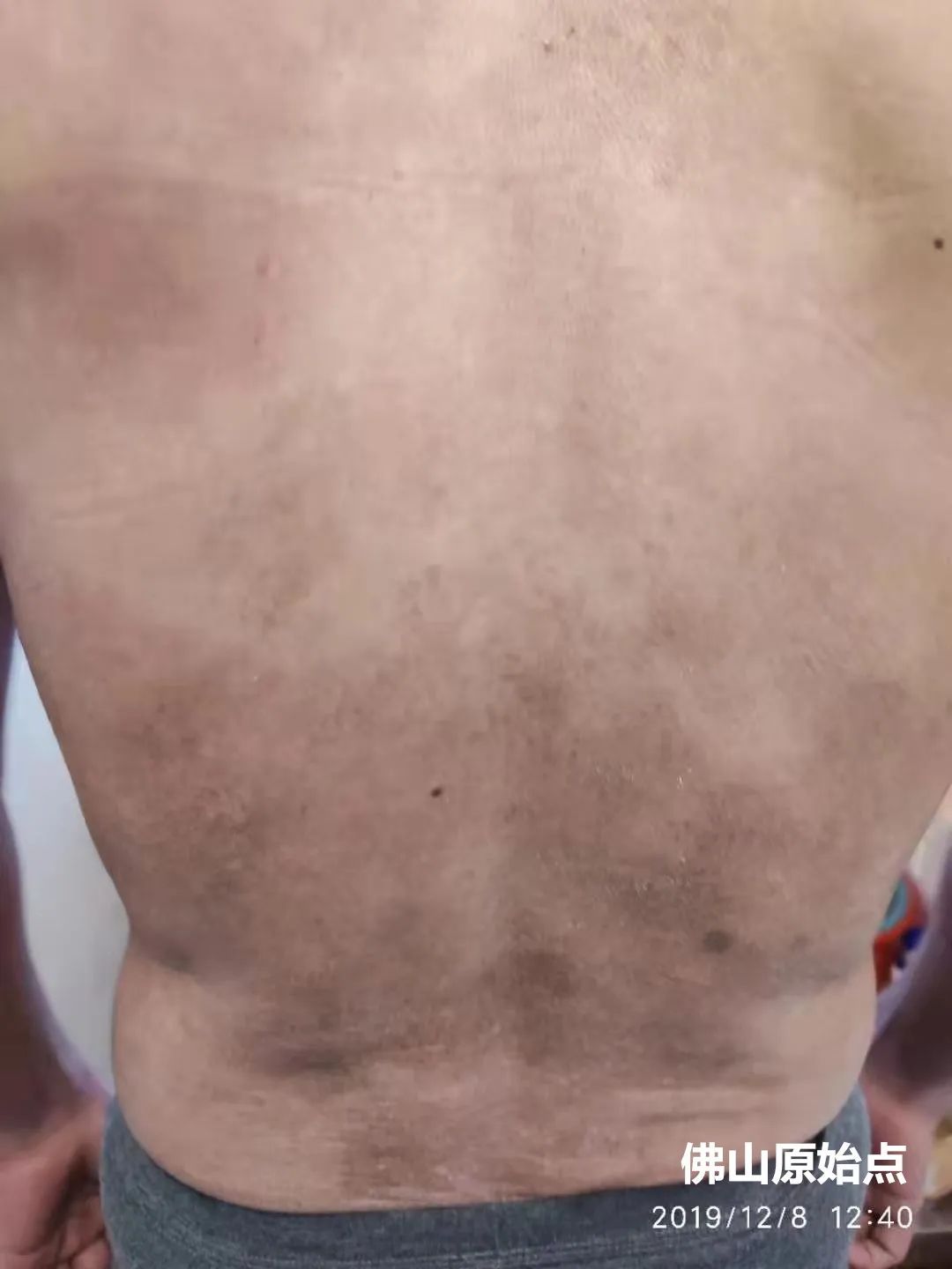 原始点调理十年牛皮癣案例 原始点调理十年牛皮癣案例