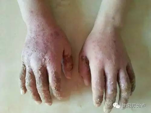 带状疱疹案例 30年顽固湿疹 便秘、肚子痛被折腾到接近命危案例 带状疱疹案例 30年顽固湿疹 便秘、肚子痛被折腾到接近命危案例