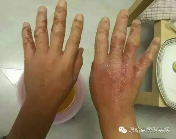 带状疱疹案例 30年顽固湿疹 便秘、肚子痛被折腾到接近命危案例 带状疱疹案例 30年顽固湿疹 便秘、肚子痛被折腾到接近命危案例