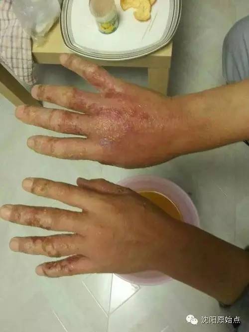 30年顽固湿疹15天痊愈 30年顽固湿疹15天痊愈