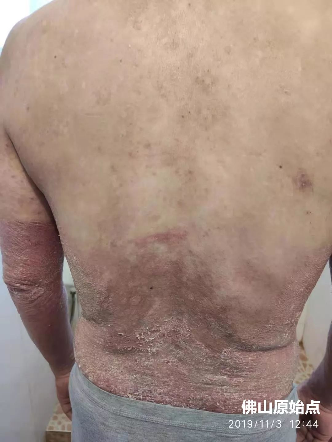 原始点调理十年牛皮癣案例 原始点调理十年牛皮癣案例