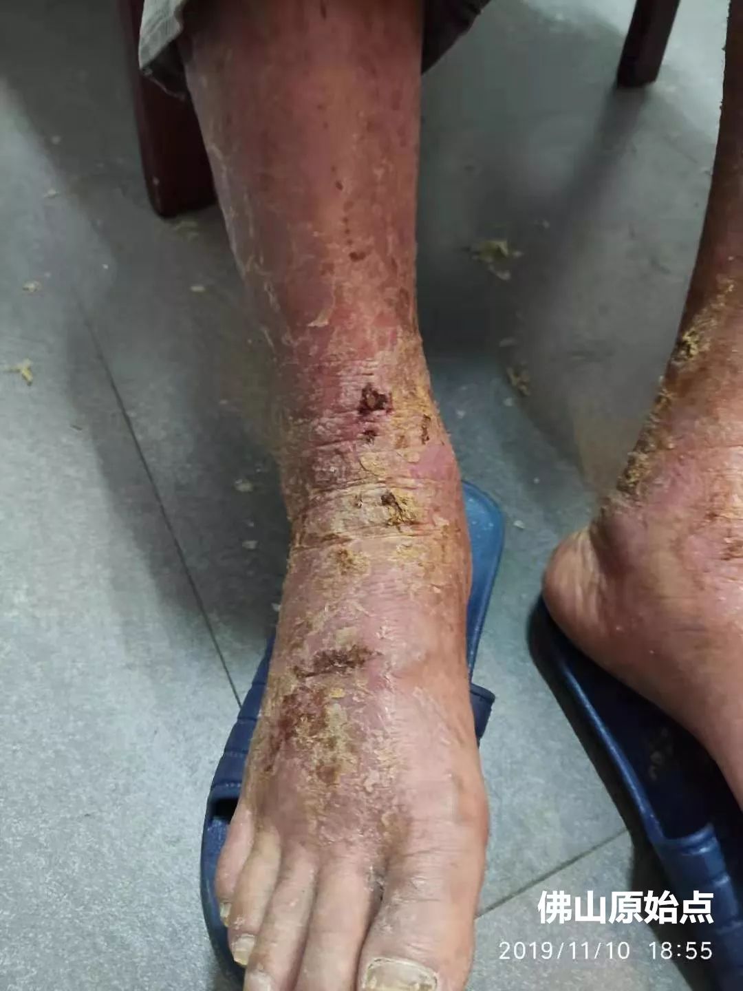 原始点调理十年牛皮癣案例 原始点调理十年牛皮癣案例