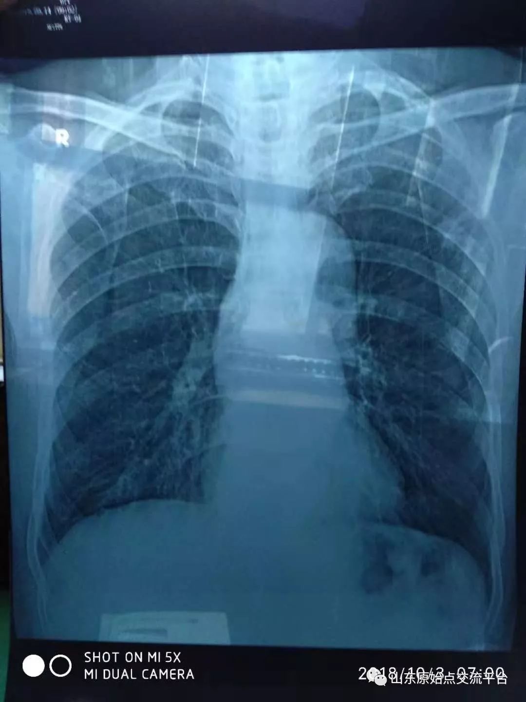 【原始点案例】河北泊头王先生肺癌康复案例 【原始点案例】河北泊头王先生肺癌康复案例