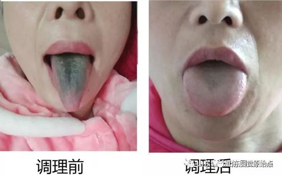 带状疱疹案例 30年顽固湿疹 便秘、肚子痛被折腾到接近命危案例 带状疱疹案例 30年顽固湿疹 便秘、肚子痛被折腾到接近命危案例