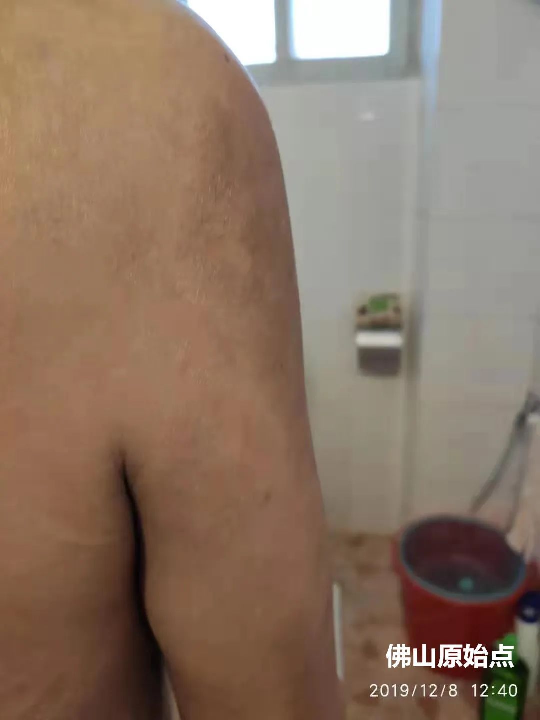 原始点调理十年牛皮癣案例 原始点调理十年牛皮癣案例