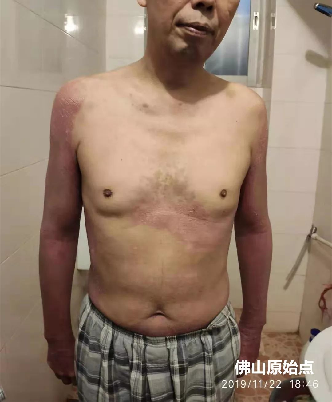 原始点调理十年牛皮癣案例 原始点调理十年牛皮癣案例