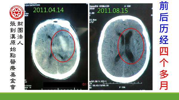 脑出血案例(钟老先生)(简体版) 脑出血案例(钟老先生)(简体版)