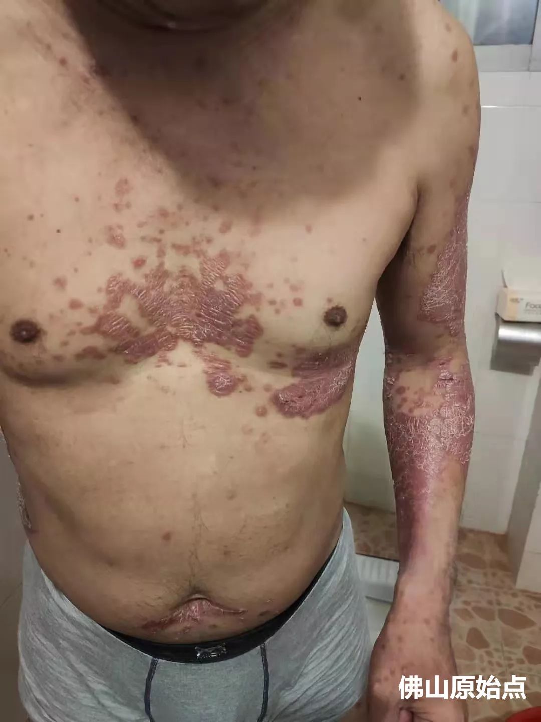 原始点调理十年牛皮癣案例 原始点调理十年牛皮癣案例